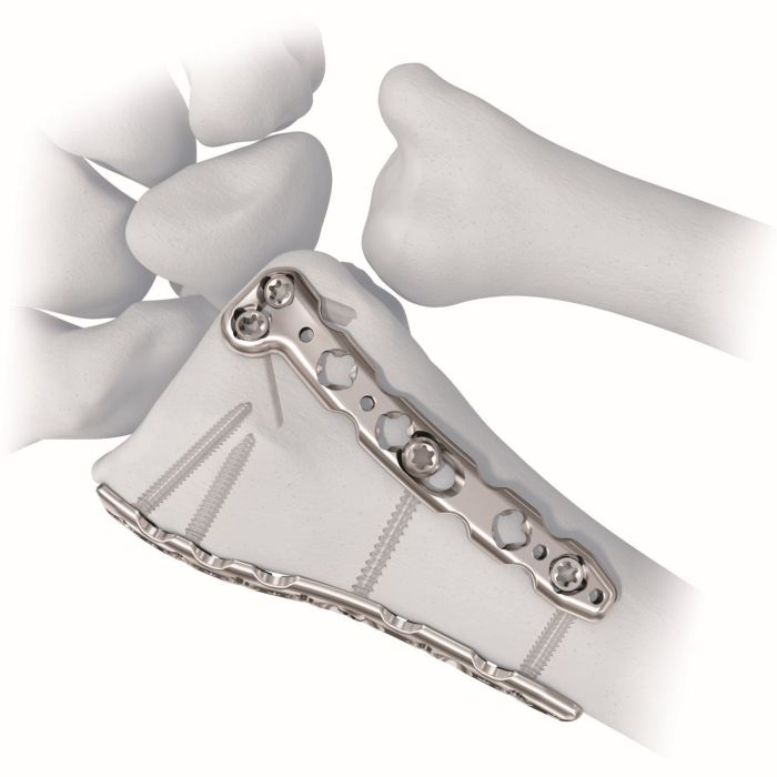 Synthes 2.4 va distal radius