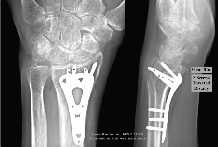 Radius distal volar rim fractures involving lunate orthopaedicprinciples facet