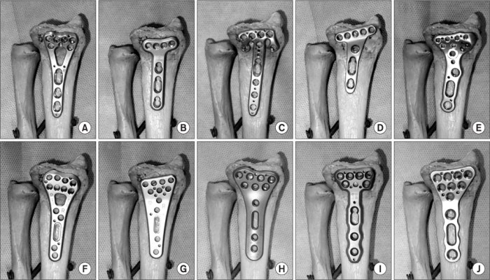 Synthes 2.4 va distal radius